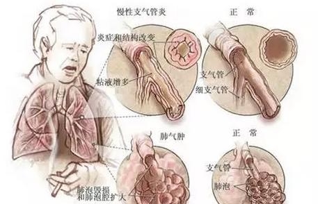 慢性阻塞性肺病（COPD）最后被“憋死” 主因是吸烟